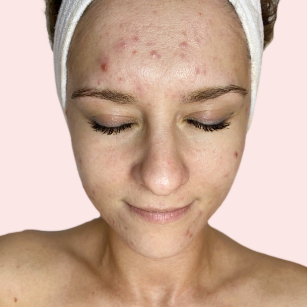 Microneedling Nachher
