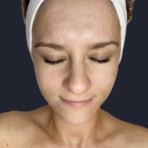 Microneedling Vorher