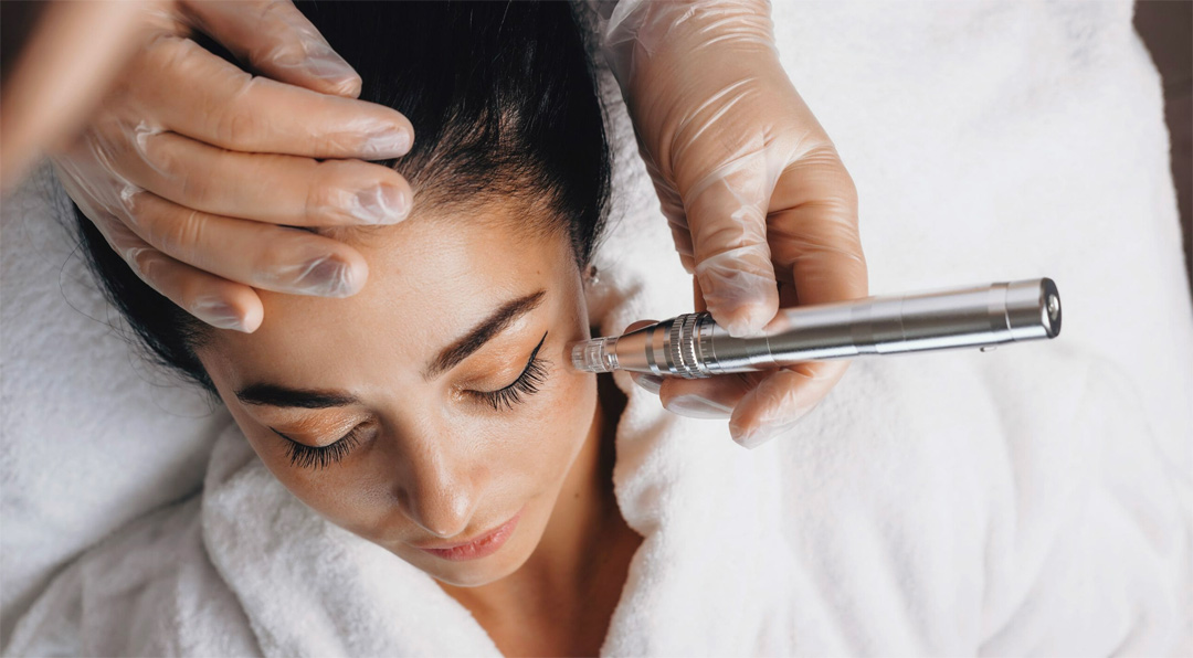 microneedling