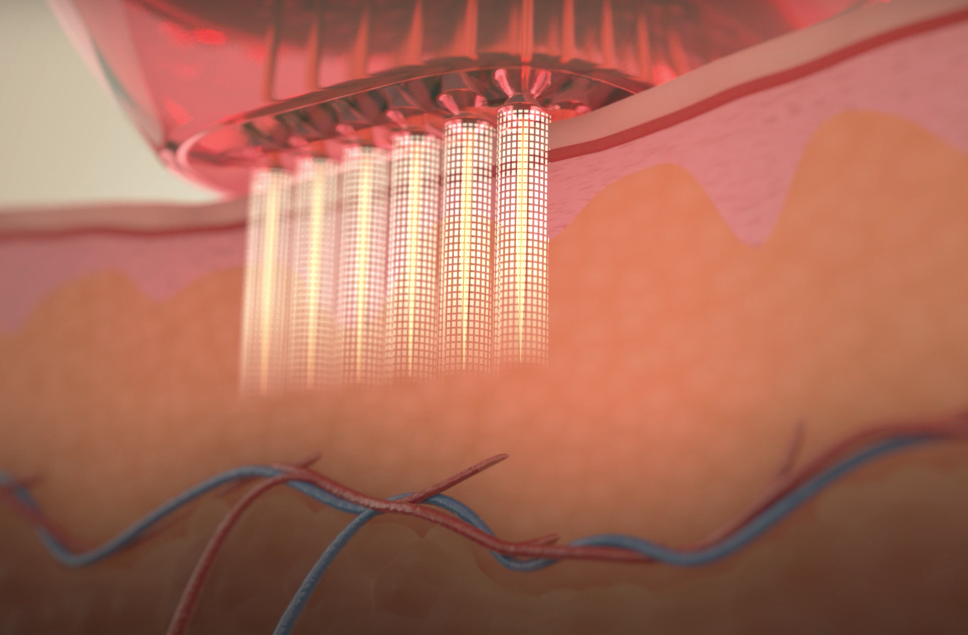 Radiofrequenz Microneedling