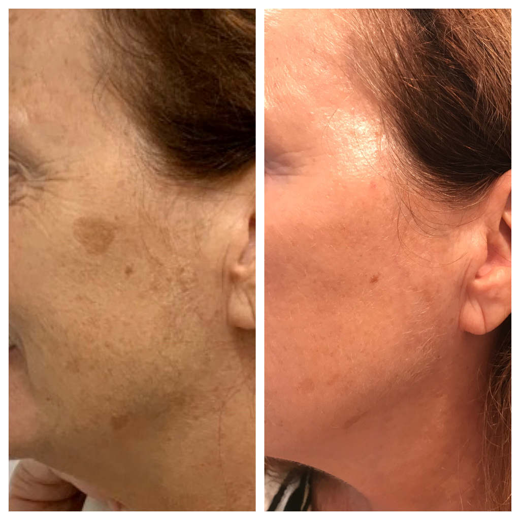 chemisches peeling