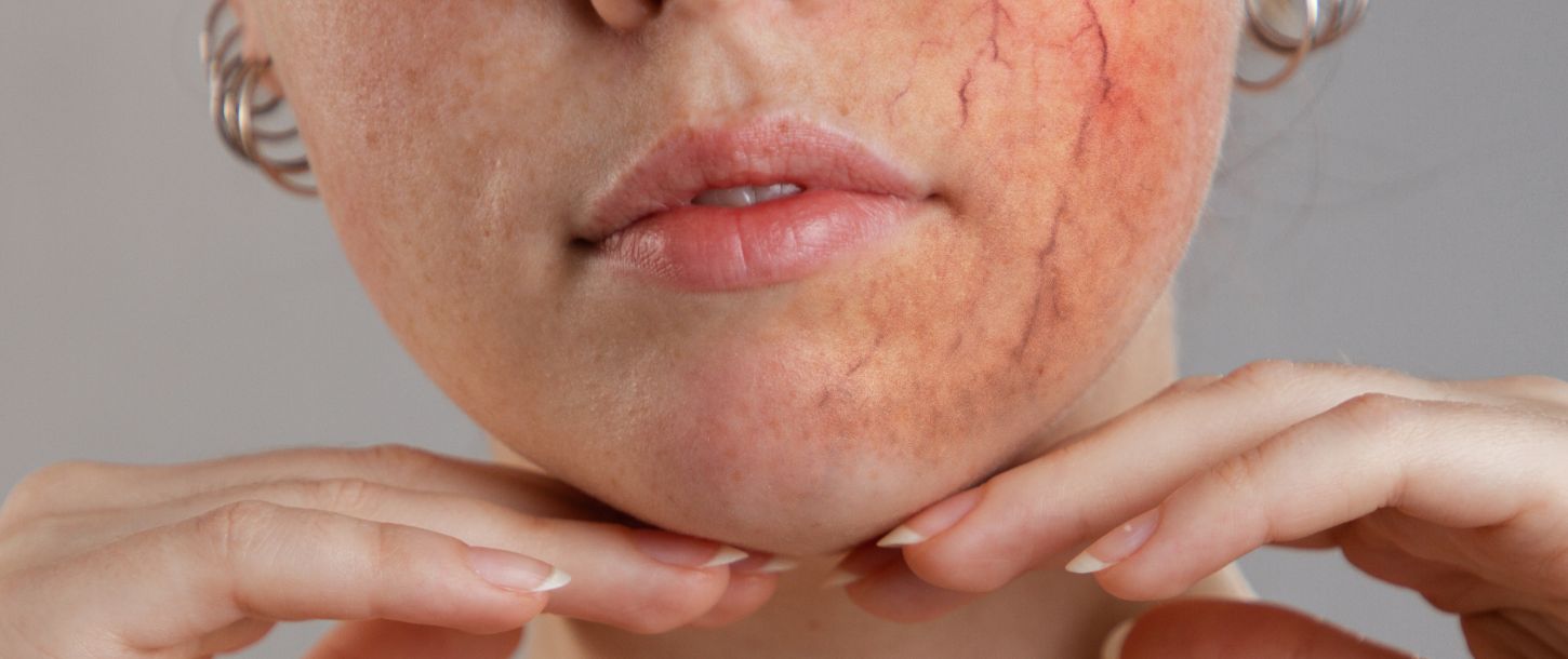 Couperose Behandlung mit Laser