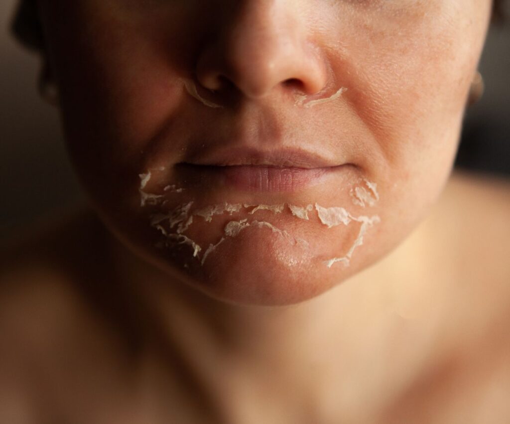 tca peeling wien