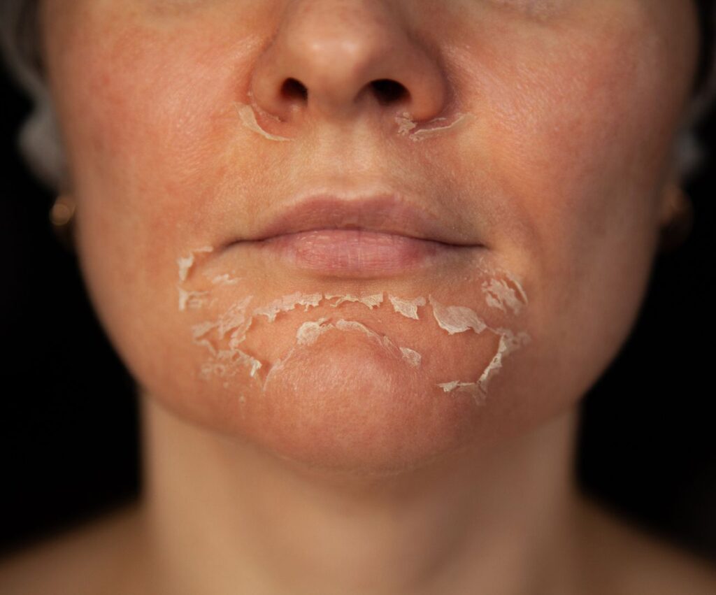 tca Peeling wien