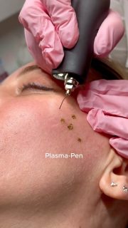 🤔 Denkst du, nur plastische Chirurgie rettet vor Falten?
Nicht unbedingt! ✨ 
Bei Individual Beauty in Wien zeigen wir dir, wie zeitlose Schönheit auch ohne Skalpell möglich ist! Wir verwandeln deinen Traum von glatter, strahlender Haut, frei von den Spuren der Zeit, in Realität – dank unseres erweiterten Spektrums an nicht-invasiven Anti-Aging-Behandlungen!👌
Wir bieten gezielte Lösungen für jeden Hauttyp und jede Herausforderung. Dein Plan – dein strahlendes Ergebnis!
🌟 Deine Vorteile bei uns:
👉 Modernste, effektive Methoden.
👉 Individuelle Behandlungspläne.
👉 Sichtbare Ergebnisse ohne Schmerzen und Ausfallzeiten.
Finde mit uns deinen Weg zu mehr Selbstvertrauen und jugendlicher Ausstrahlung.
Wir laden dich herzlich zu einer persönlichen Beratung ein, um gemeinsam den idealen Anti-Aging-Plan zu finden!
#beautytreatment #wien #vienna #individualbeautywien #beautyvienna #kosmetikwien #microneedling #kaltplasma #laserbehandlung #skincarevienna #beautyinnovation #antyagingskincare #skincarecommunity #glowingskin #austria #wienliebe