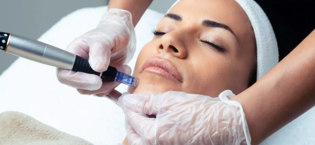 microneedling gallery 1