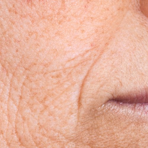 wrinkles