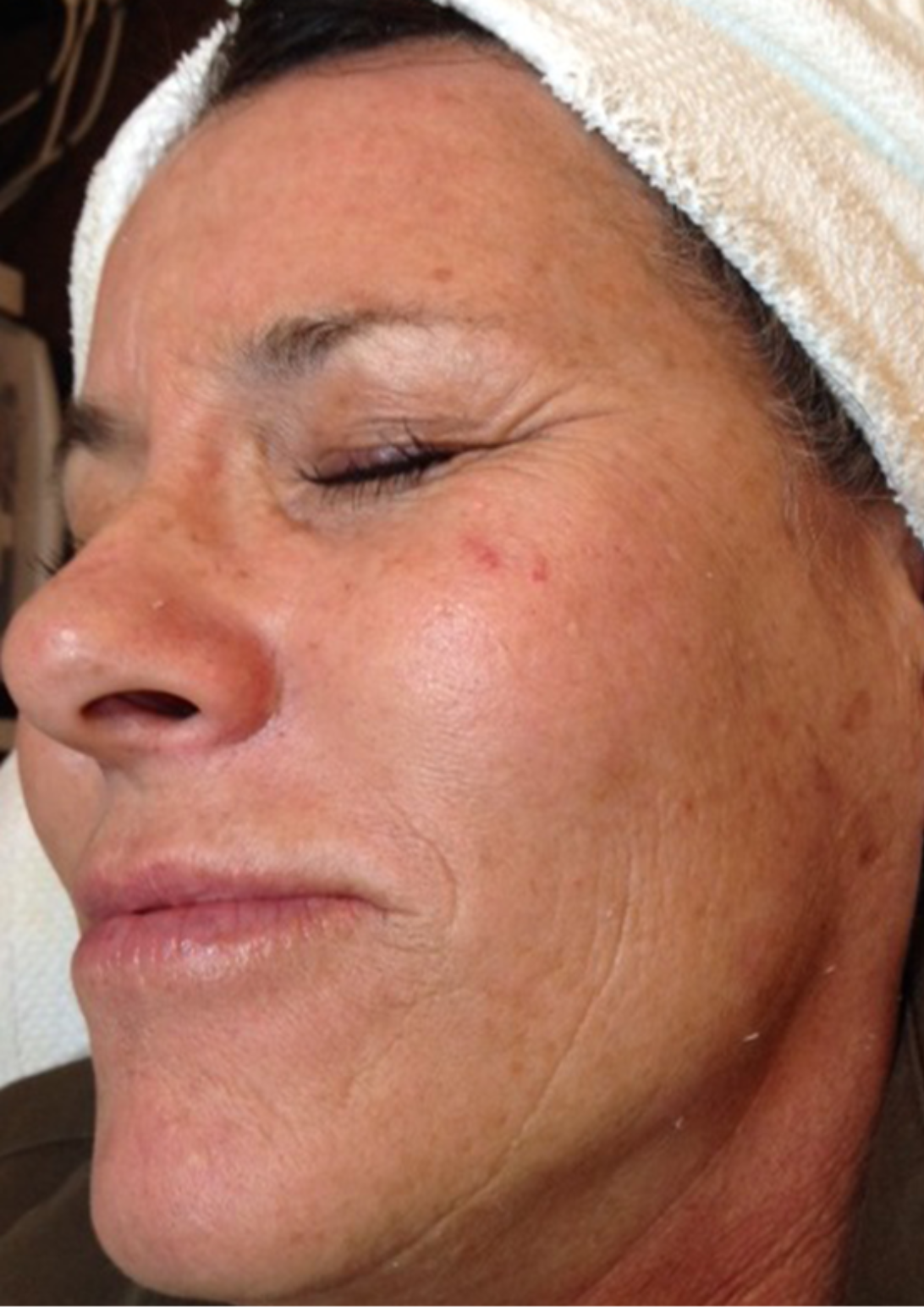 microdermabrasion wien