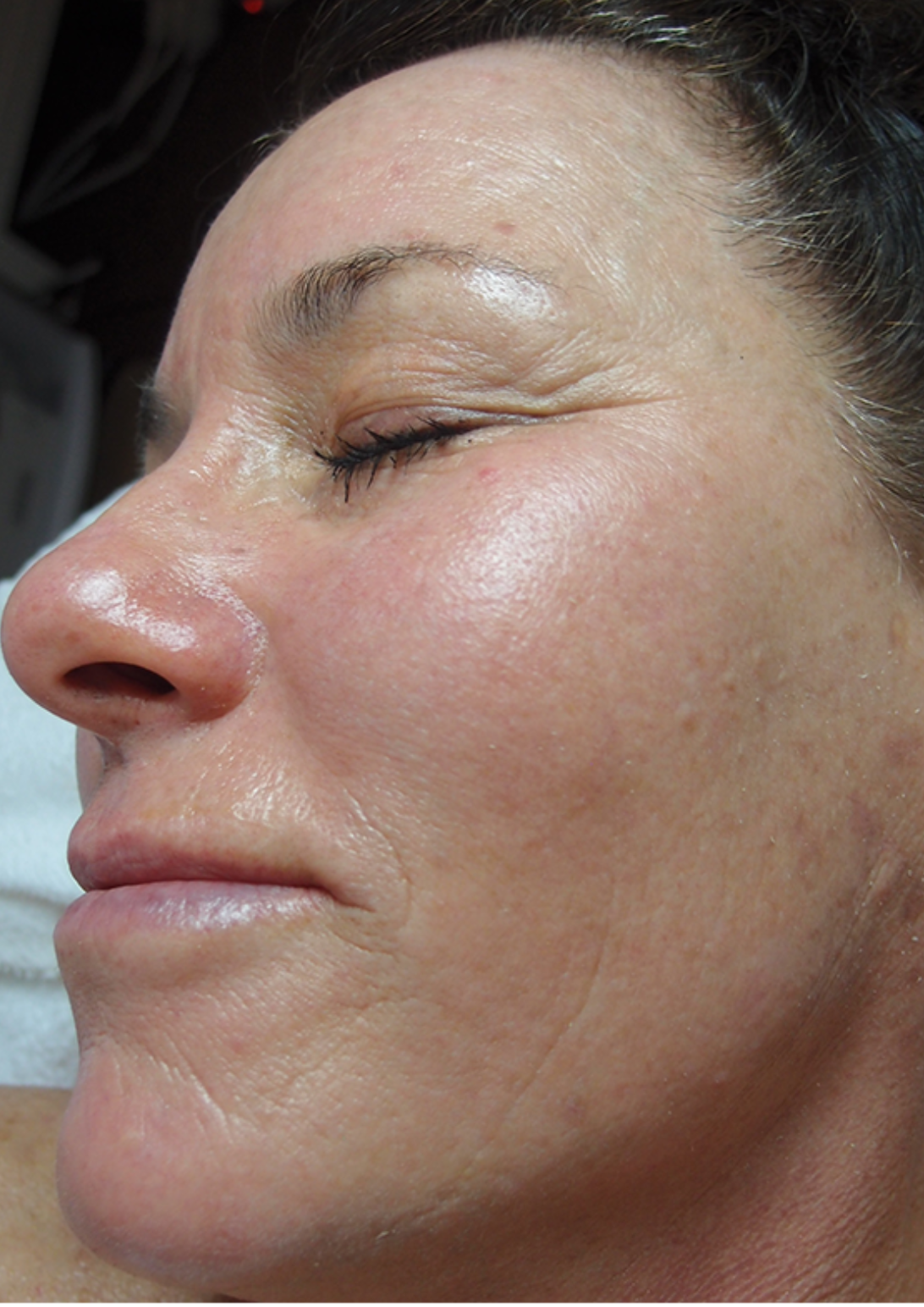 microdermabrasion wien