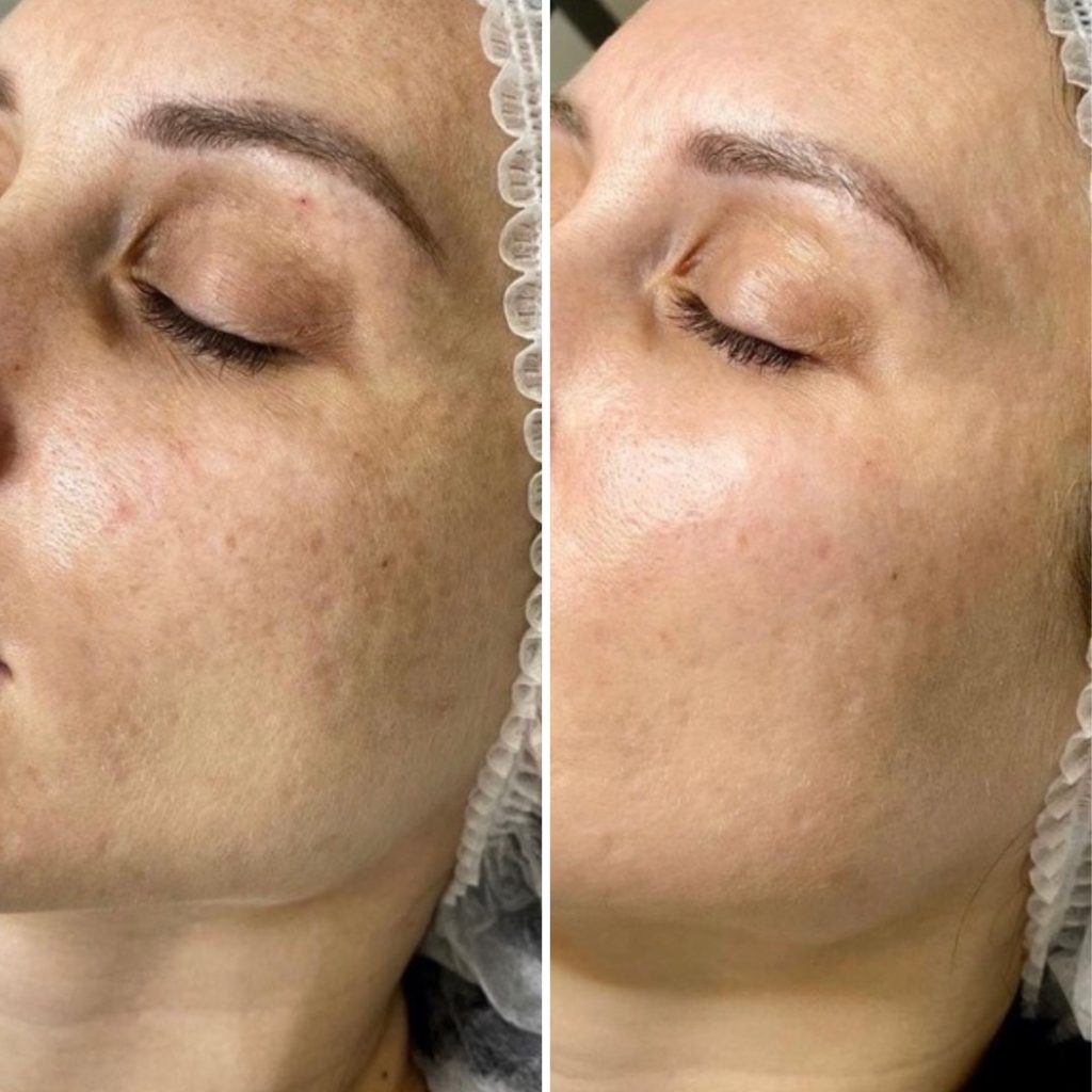 carbon laser peeling