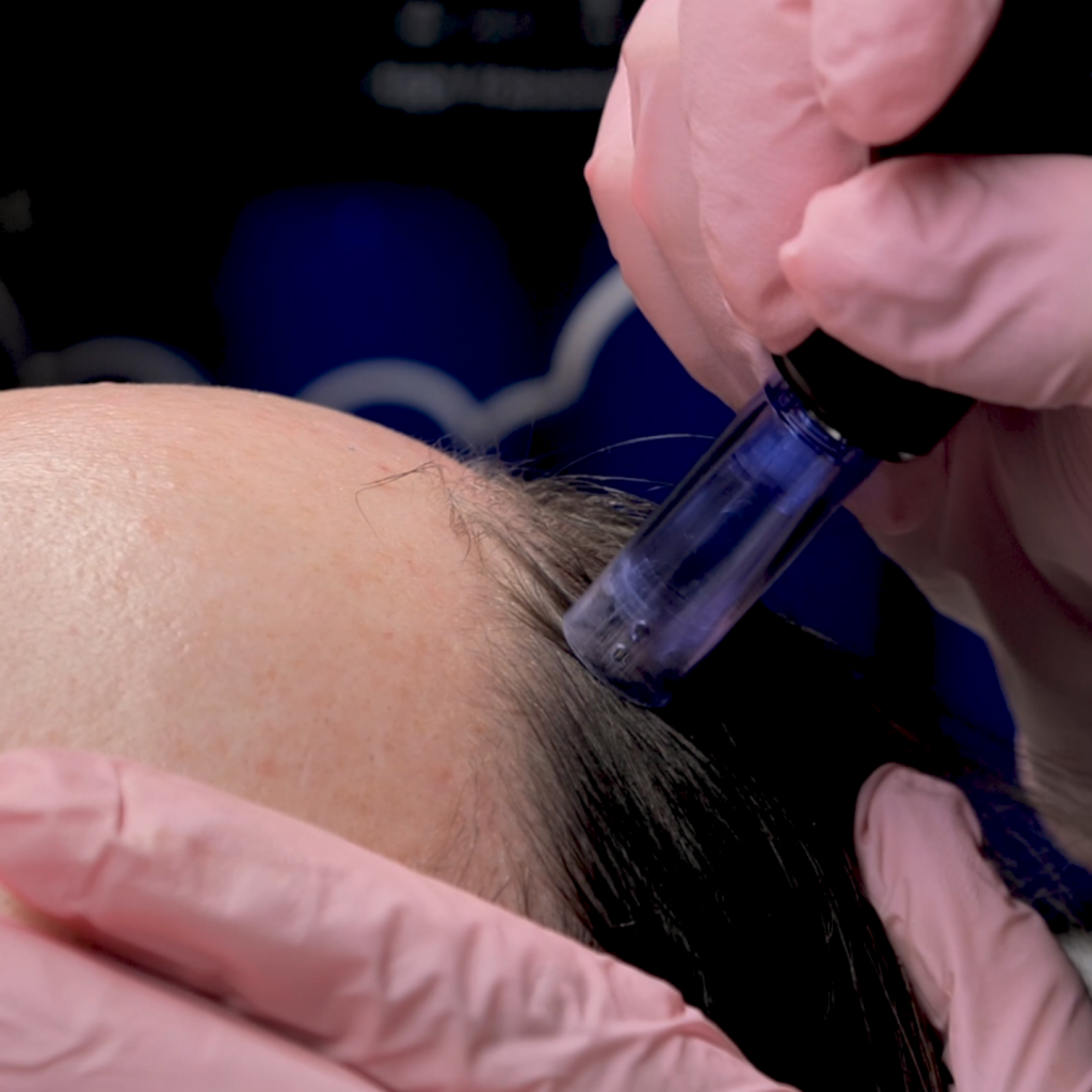 microneedling