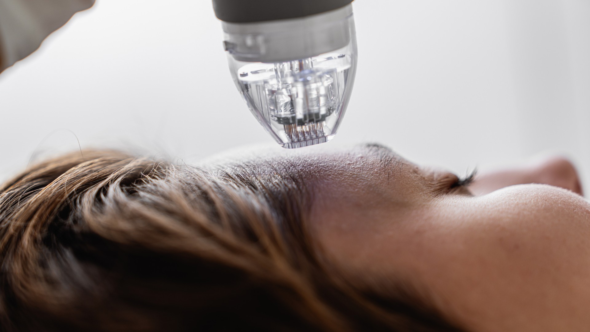 RF Needling
