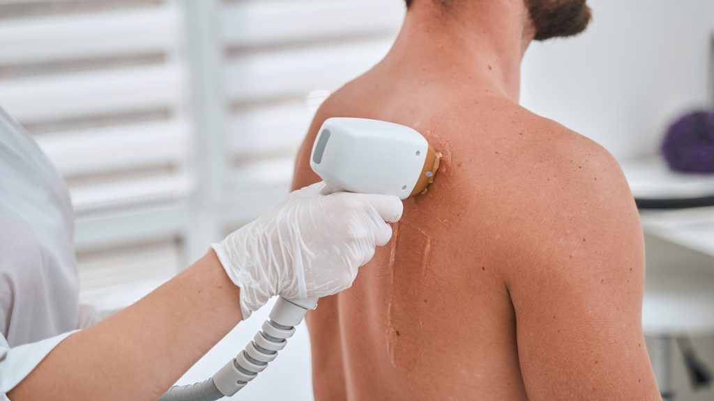 LaserHair Removal 2