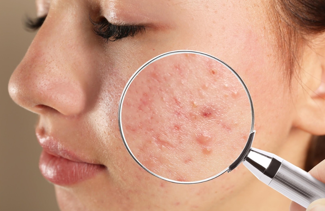mesoestetic product types 3