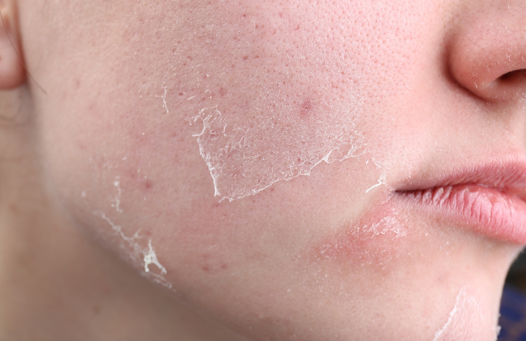 mesoestetic product types 5