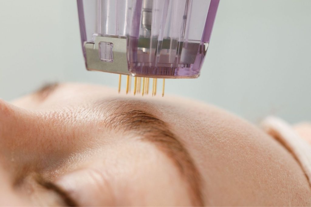 radiofrequency microneedling 2