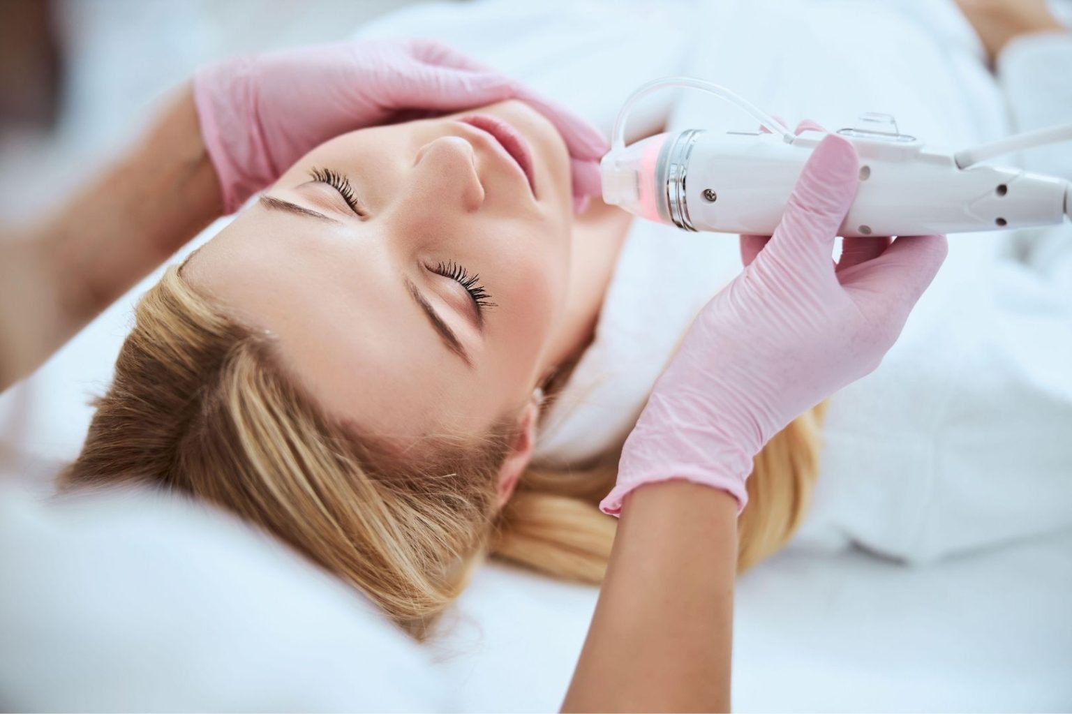 radiofrequency microneedling 3