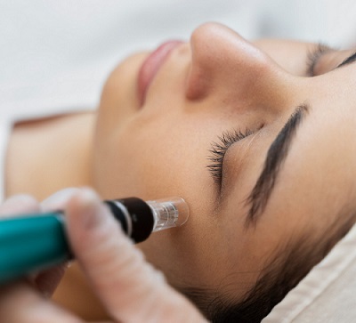 Microneedling vorher nachher augen