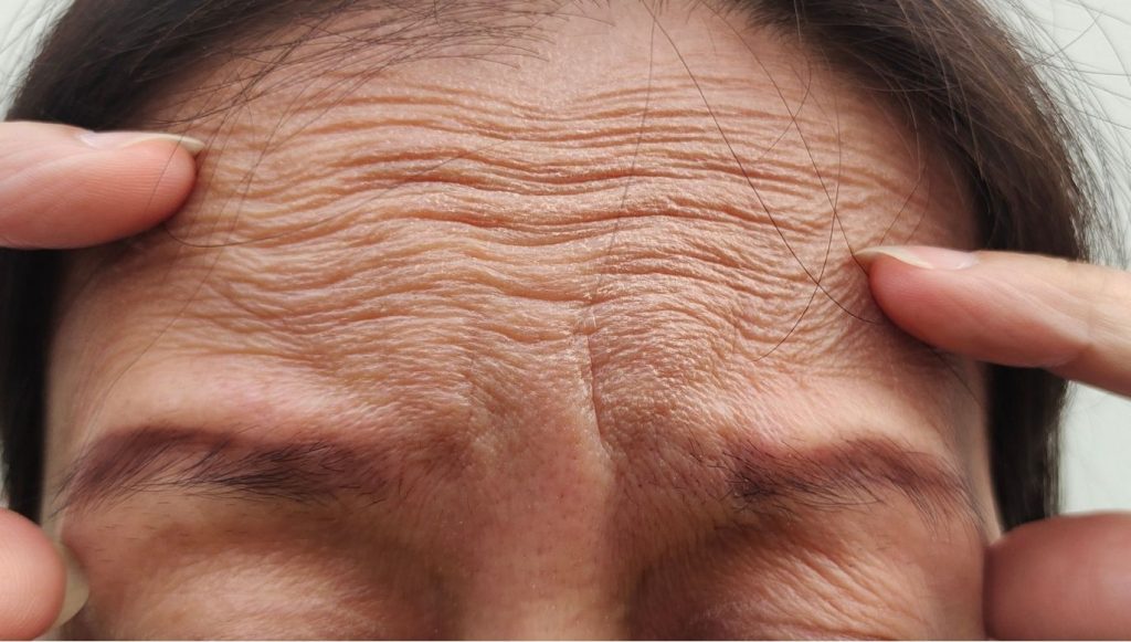 Stirnfalten glaetten ohne OP – sanfte Anti Aging Behandlungen bei Beauty Wien 1