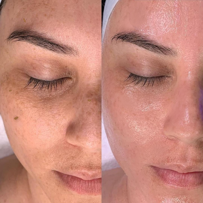 hydrafacial before and after 2 1