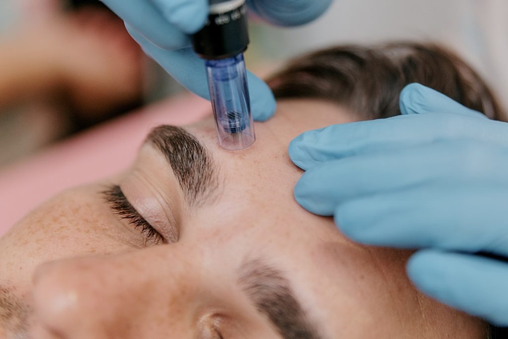 Microneedling männer
