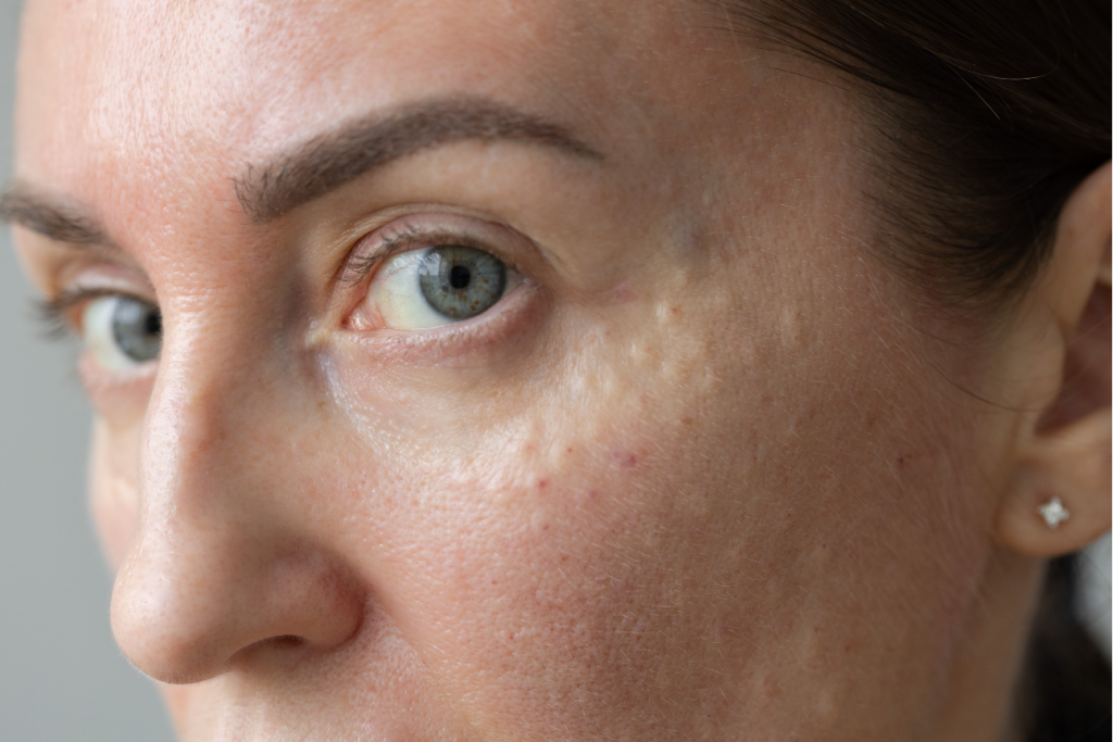 blackheads blocked pores 1