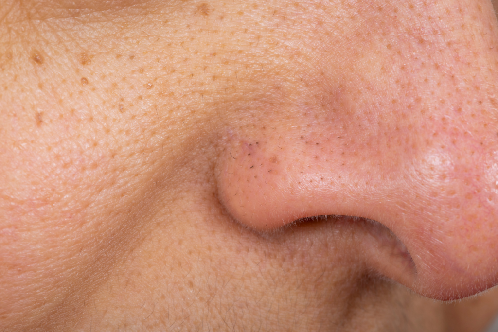 blackheads blocked pores