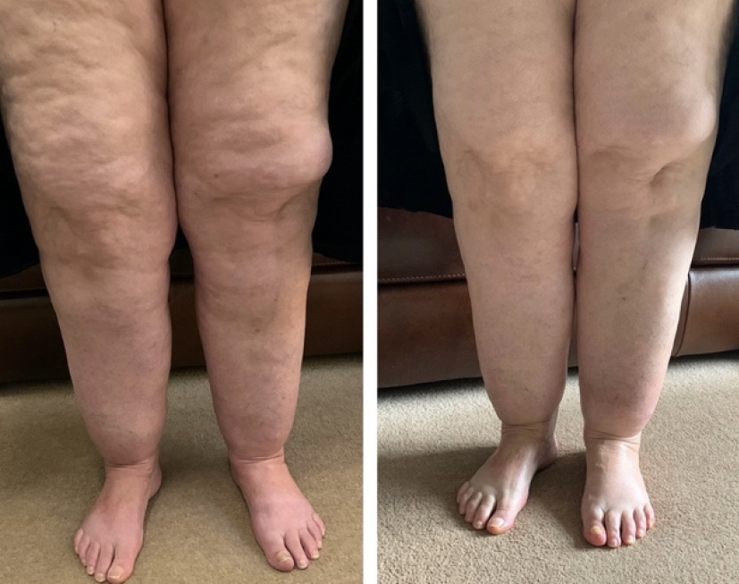 lymphdrainage bevor nachher