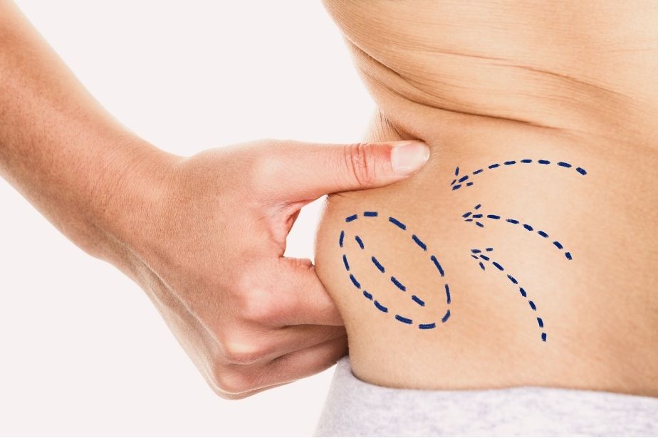 Liposuction 1