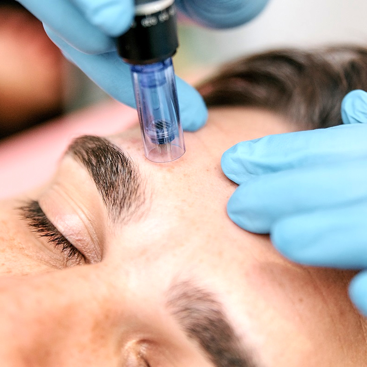 Microneedling Behandlung bei Individual Beauty
