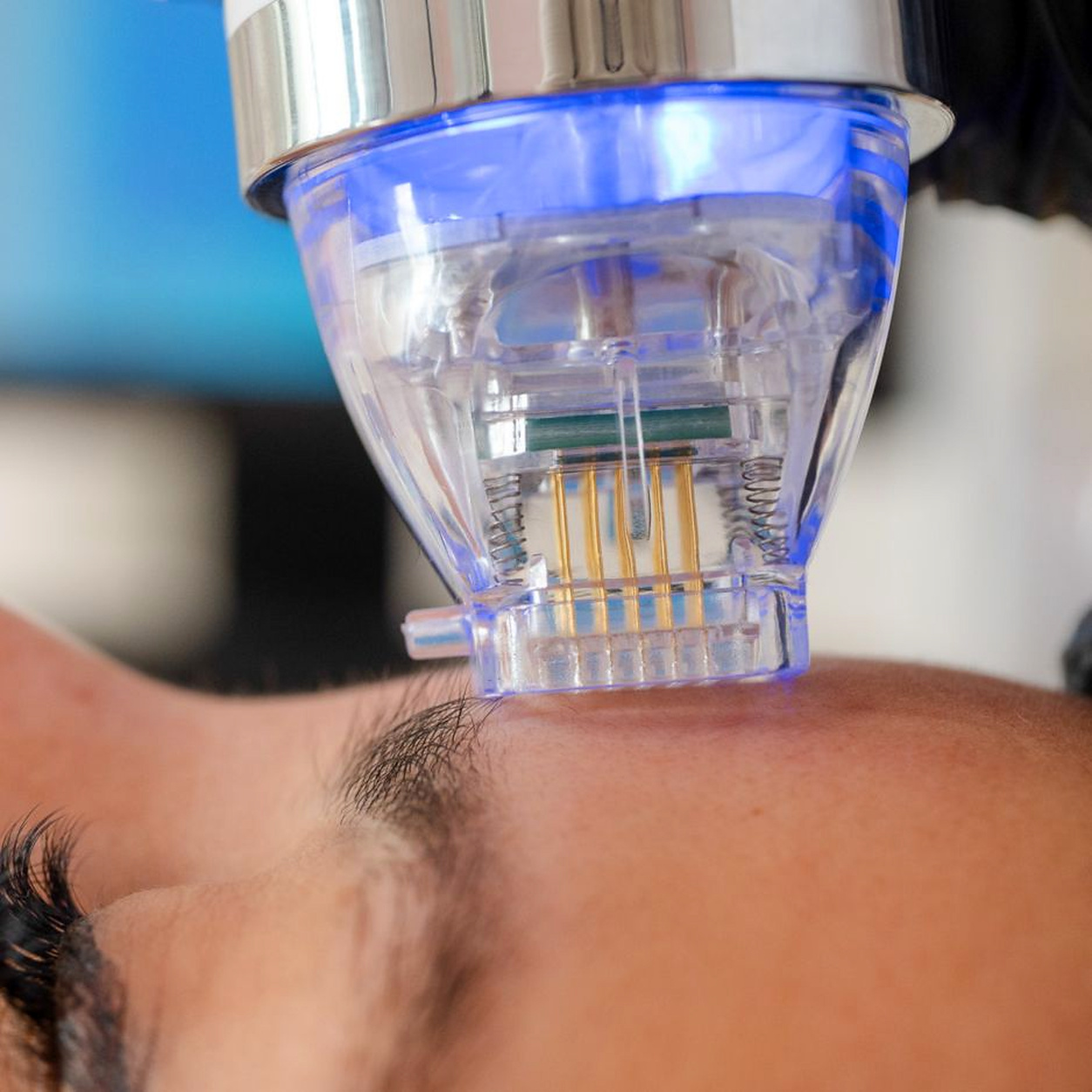 Radiofrequenz Microneedling RF Needling bei Individual Beauty