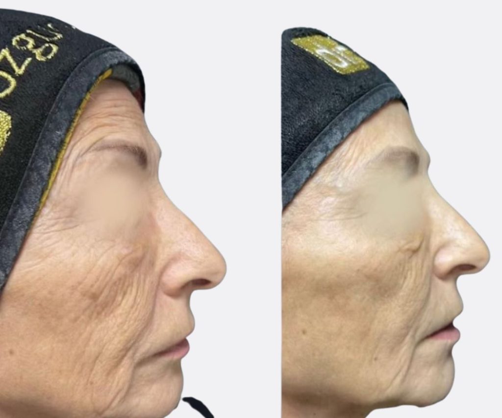 Dermal longevity