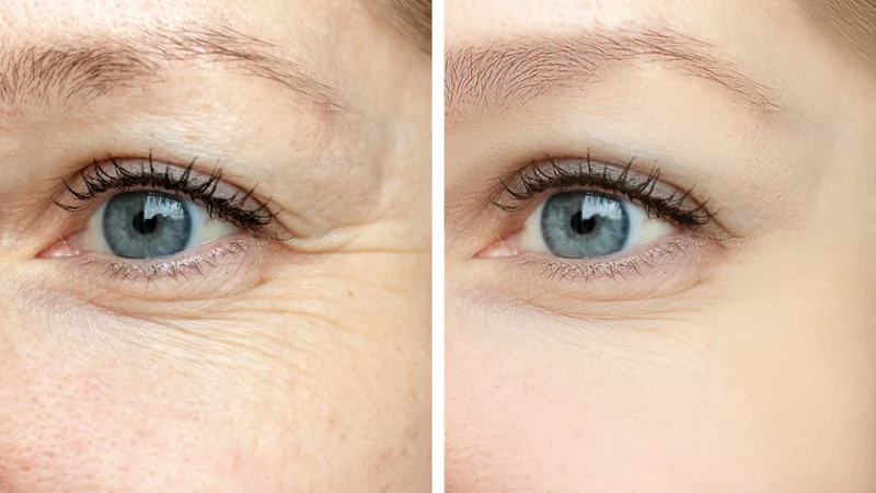 Anti Aging Behandlung Wien