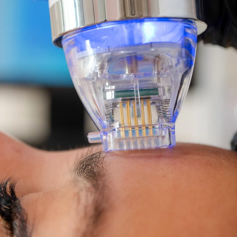 Radiofrequenz Microneedling RF Needling bei Individual Beauty