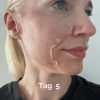 TCA Peeling 1. Sitzung