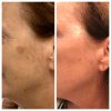 Retinol + Exosomen Peeling