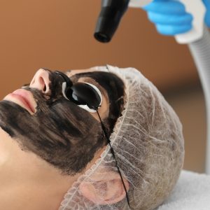 carbon peeling kosten