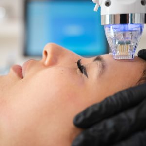 Radiofrequenz Microneedling
