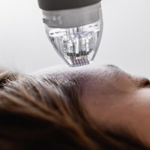 RF Needling