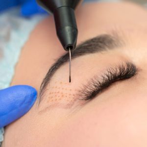 Plasma Pen Behandlung Wien